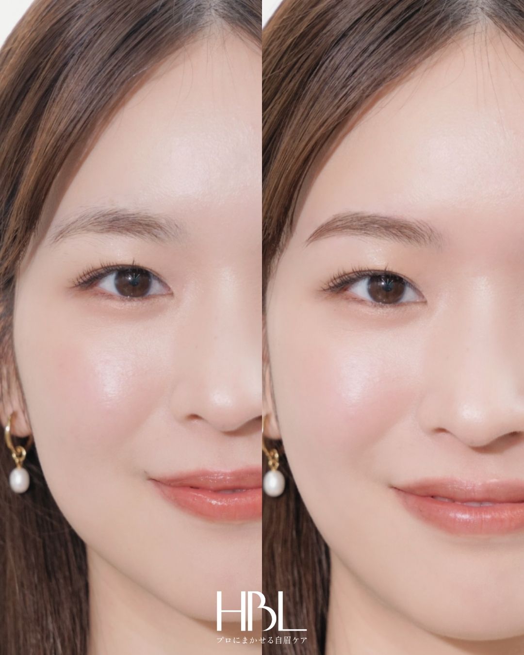 HBL（ハリウッドブロウリフト）の施術例