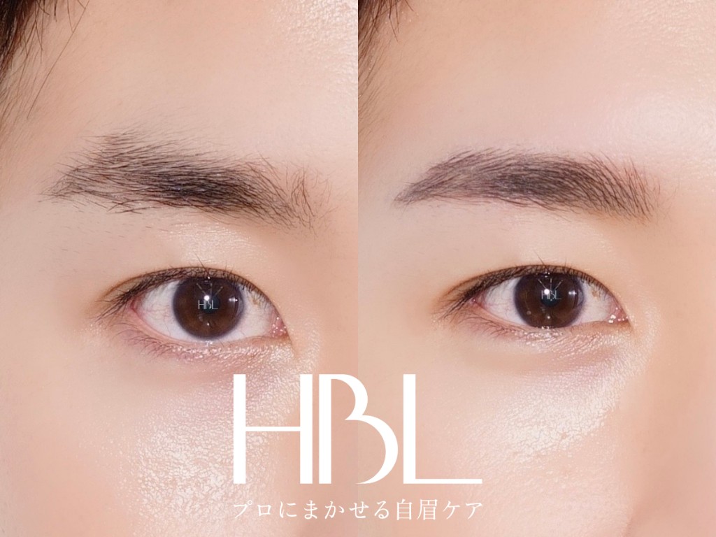 HBL（ハリウッドブロウリフト）の施術例