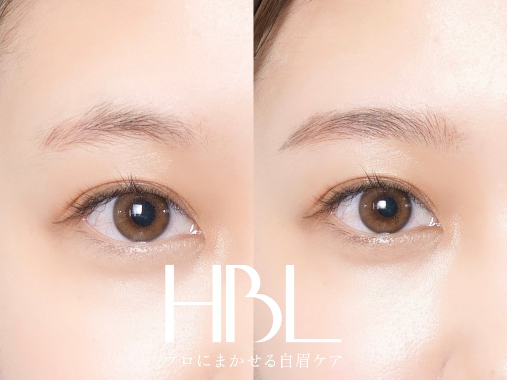 HBL（ハリウッドブロウリフト）の施術例