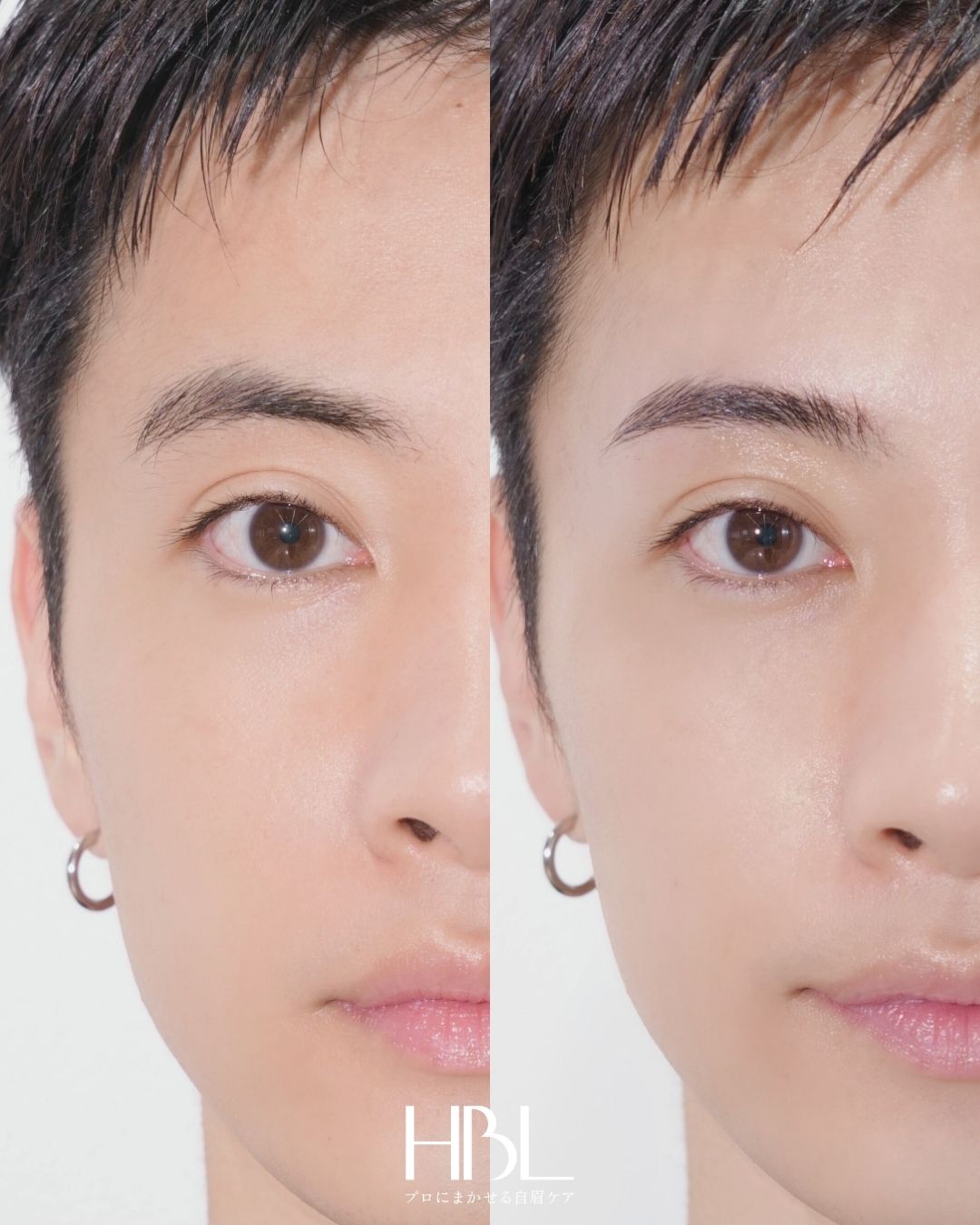 HBL（ハリウッドブロウリフト）の施術例